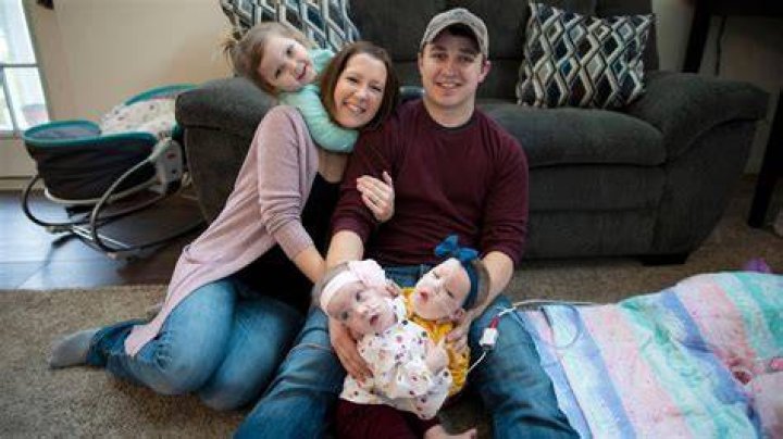 Conjoined twins believed Michigan's 1st to be successfully separated