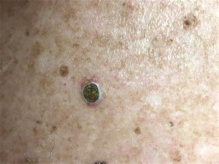 Dilated pore Stock Image C028/4430 Science Photo Library