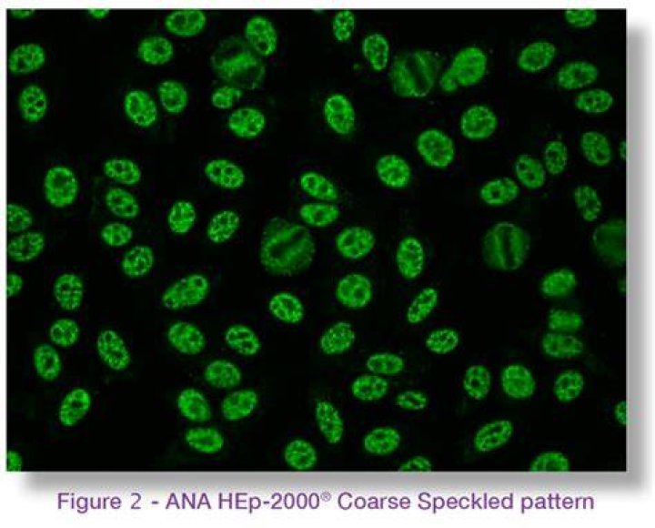 Positive Ana Speckled Pattern Chumado