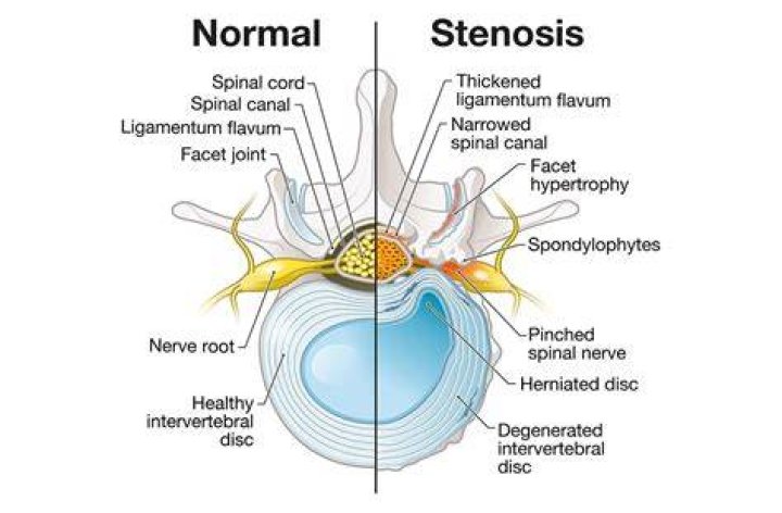 Spinal Stenosis Carolina Regional Orthopedics